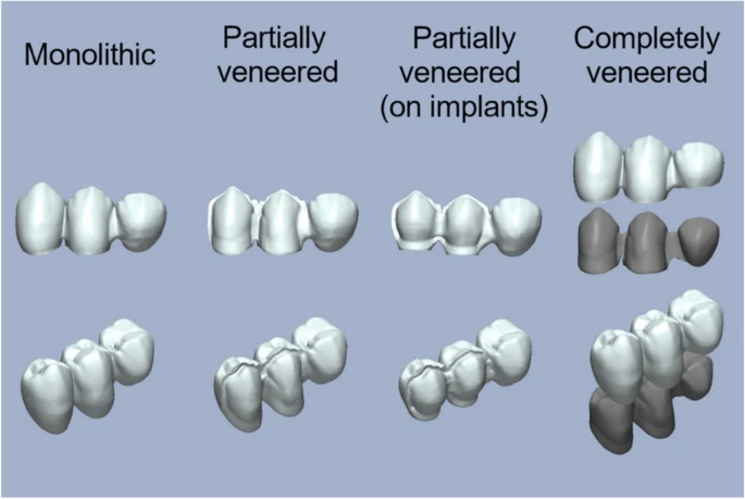 Initial damage and failure load of zirconia-ceramic and metal-ceramic posterior cantilever fixed partial dentures