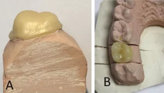 Emerging trends and clinical recommendations for zirconia ceramic crowns: a concise review