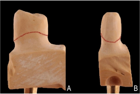 Three-year clinical evaluation of zirconia and zirconia-reinforced lithium silicate crowns with minimally invasive vertical preparation technique