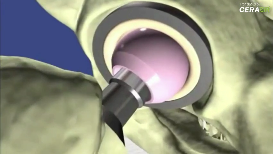 BIOLOX® - CeramTec Competence in Ceramic Joint Components