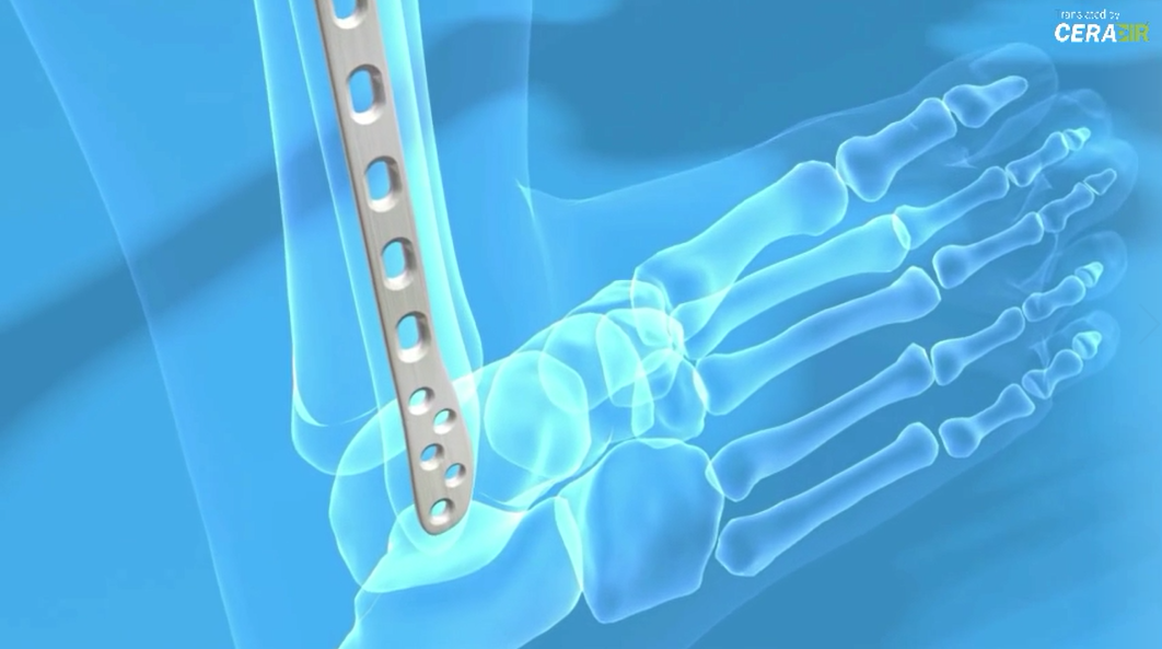 CeramTec Medical Engineering (2013)